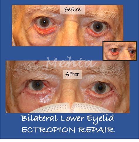 Entropion Surgery DC | Ectropion Repair Chevy Chase