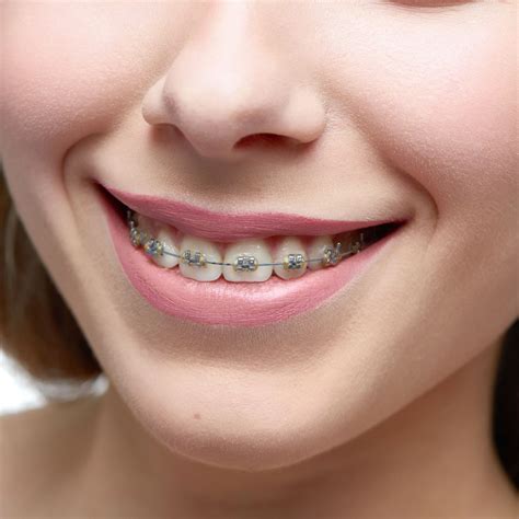 top  south houston braces maintenance tips