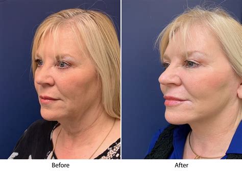 mini facelift options  enhanced appearance  los altos