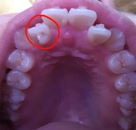 Has anyone ever dealt with teeth with talon cusps or dens in dente and