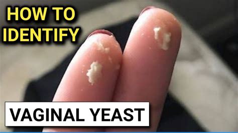 Vaginal Yeast Infection Discharge On Finger