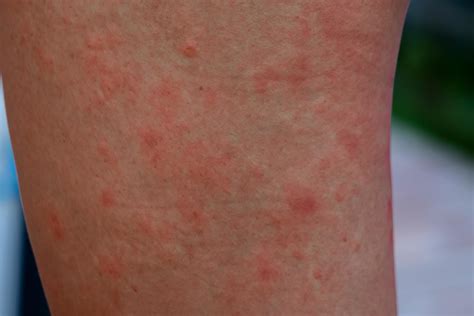 Strong allergic rashes on the body Impaired immunity and reaction to