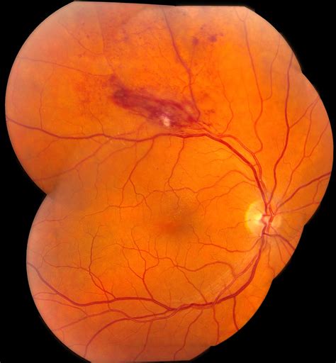 Whitman Images: BRVO: Branch Retinal Vein Occlusion