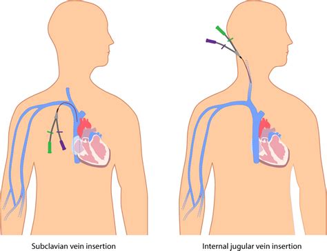 intravenous fluid therapy clinical procedures  safer patient care