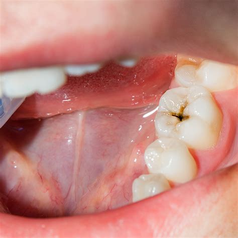 cavities white pine family dentistry hamilton