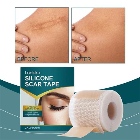 Fita De Silicone Para Cicatriz Antes E Depois - Folhas de Silicone para Cicatrizes, Fita de Silicone para Cicatrizes ...