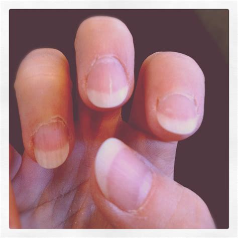 I Broke A Fingernail! How To Cope With A Broken Fingernail – Classical