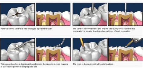 COMPOSITE FILLING - DocDentalSmile