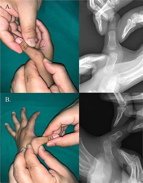 frontiers characteristics  congenital clasped thumb  case report