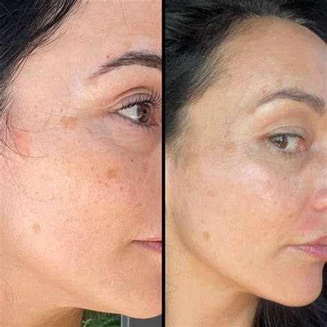 Depigmentation Kit - Discoloured Skin – Windyigarn Natural Skin Care
