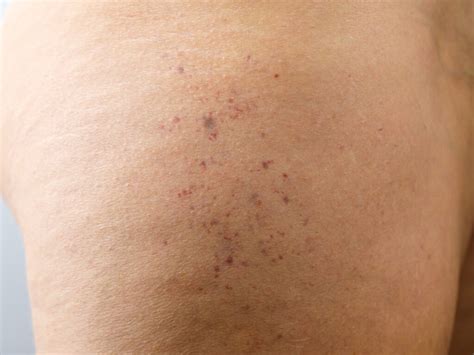 broken blood vessels treatment  portland  key laser institute