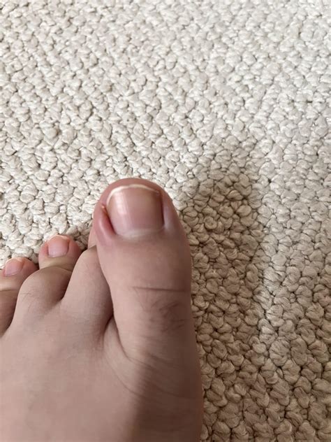 Question : r/Ingrown_Toenails