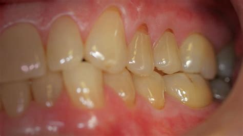 Noncarious Cervical Lesions and the Abfractive Process