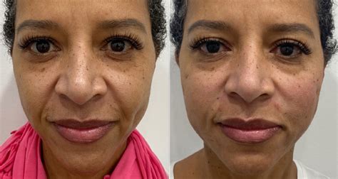 Thread Lift: Procedure, Skin Outcomes, Pics & Cost