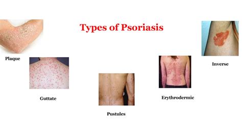 Pictures of psoriasis types | Symptoms and pictures