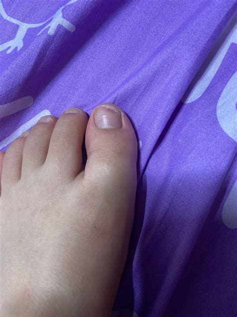 My toe hurts and it looks a bit strange. Someone please explain : r/medical