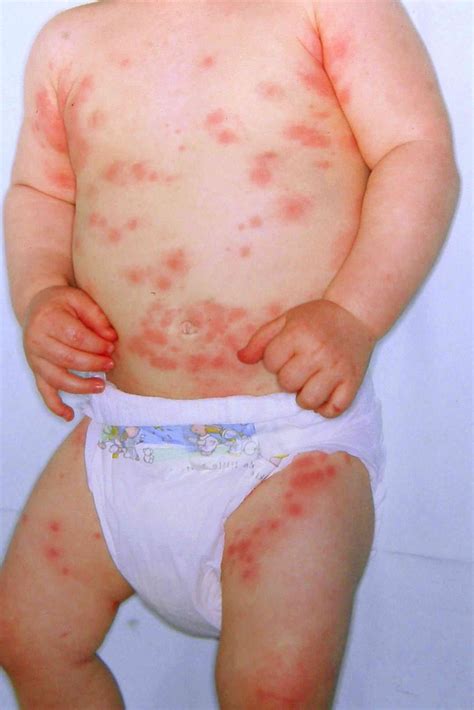 Baby Allergic Reaction To Food