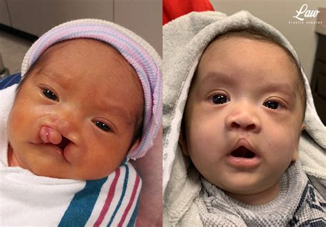 Cleft Lip Repair, Primary Bilateral Before & After Photos - Law Plastic ...