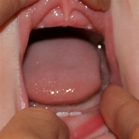 The difference between natal and neonatal teeth | News | Dentagama