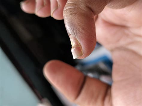 Will the nail grow back ? : r/Psoriasis