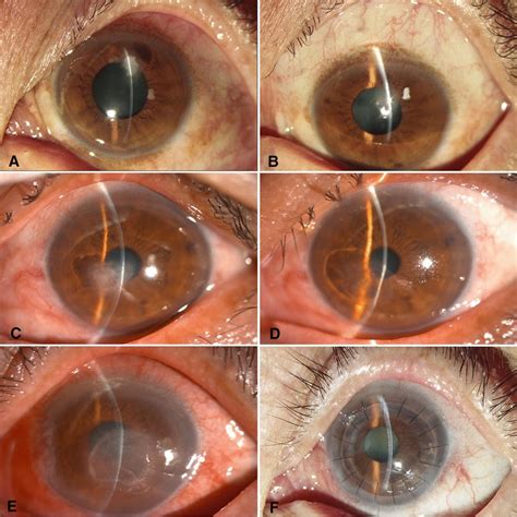 Slit Lamp Exam Corneal Abrasion