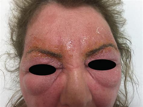 Periorbital Edema Hypothyroidism
