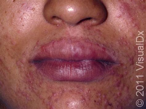 What Is Perioral Dermatitis? Symptoms, Causes, Diagnosis, pregnancy rash under breasts ...