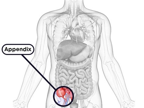 Appendicitis: Causes, Symptoms, Diagnosis & Treatment - Boldsky.com