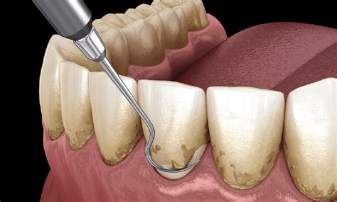 Teeth Scaling & Polishing - Surana Dental Clinic