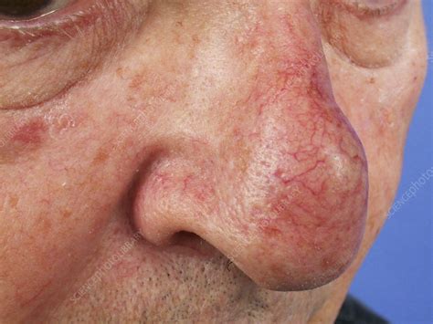 angioma stock image  science photo library