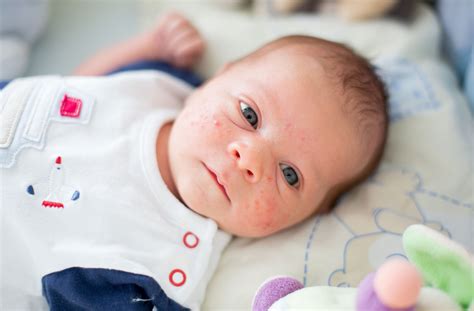 Baby rash: A visual guide to skin rashes in babies and children