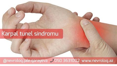 Karpal Tunel sindromu | Dr. Jalə Qarayeva