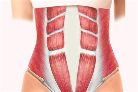 Diastasis Recti – Absolute Physio