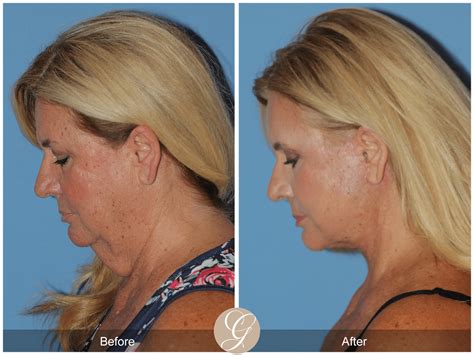 Deep Plane Facelift & Deep Plane Necklift Case 2 Before After Photos ...