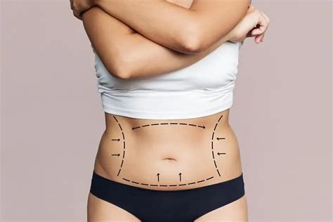 Lipedema Surgery Made Easy: Say Goodbye to Stubborn Fat