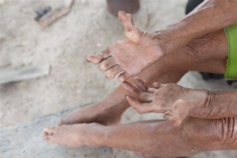 Signs and Symptoms of Hansen's Disease | Hansen's Disease (Leprosy) | CDC