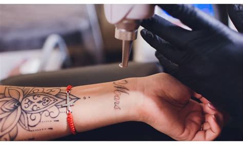 how much does it cost to get tattoos removed