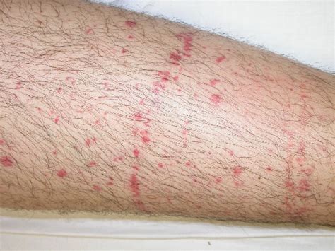pinpoint red spots   skin petechiae urwolf