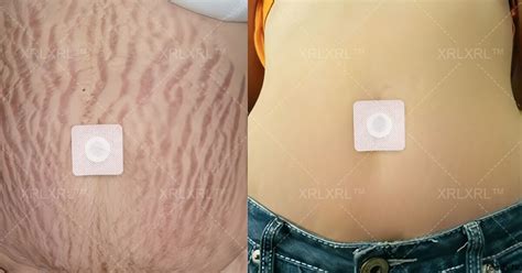 XRLXRL™ Potent HerbIon Negative Ion Detox Slimming Patch - Miraystore