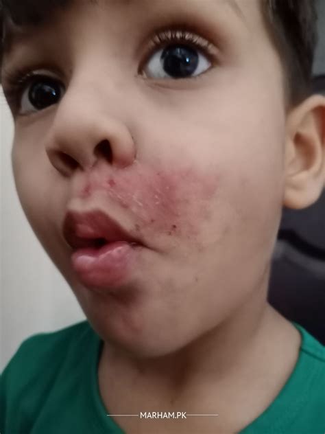 dermatologist   face skin burn