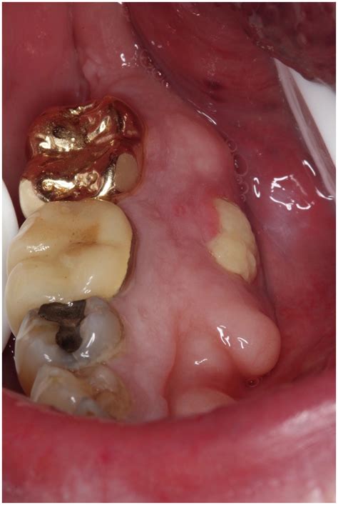 Osteonecrosis Of Jaw Symptoms