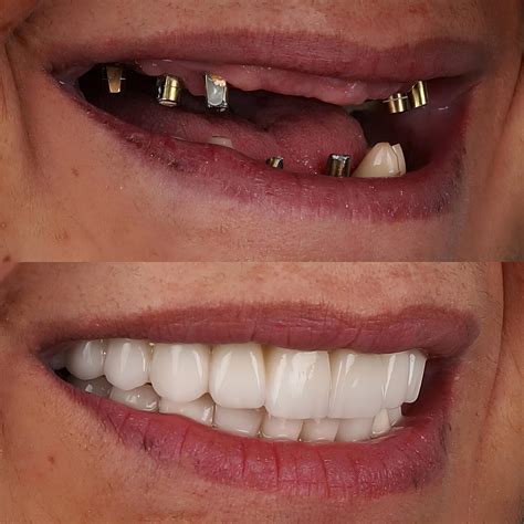 Restore Your Smile with Dental Implants