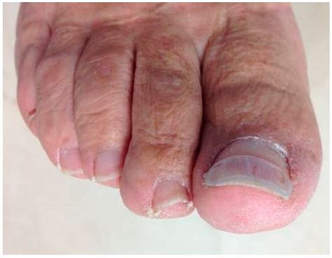 Ingrown Toenail Treatment Cotton