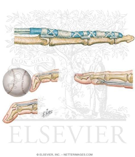 Flexor Tendon Anatomy and Injuries