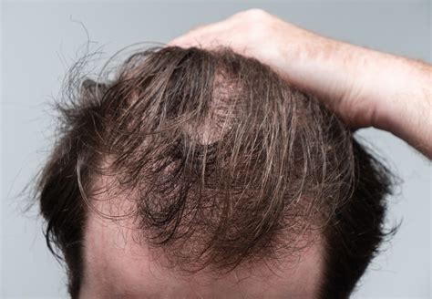 Oral Minoxidil For Hair Loss | Ziering Medical