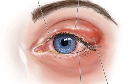 Olhos Vermelhos E Coçando
