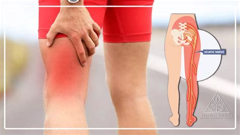 Sciatica; Common Causes, Symptoms, Diagnosis & Treatment - Fulcrum Therapy