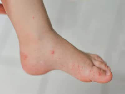 Is Your Child Suffering From HFMD Disease? How To Prevent It In ...