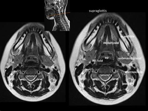 MRI in neck imaging