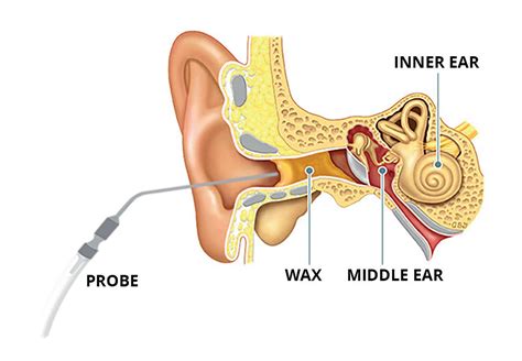 Ear Wax Removal Hobart | Ear Wax Removal Near Me - Maria Brown Hearing ...